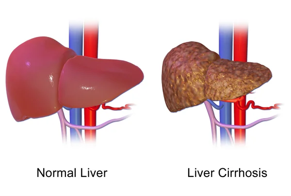 Cirrhosis